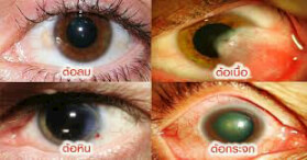 ดวงตาไม่ออกแบบมาให้กัน uv ใส่แว่นเถอะครับ