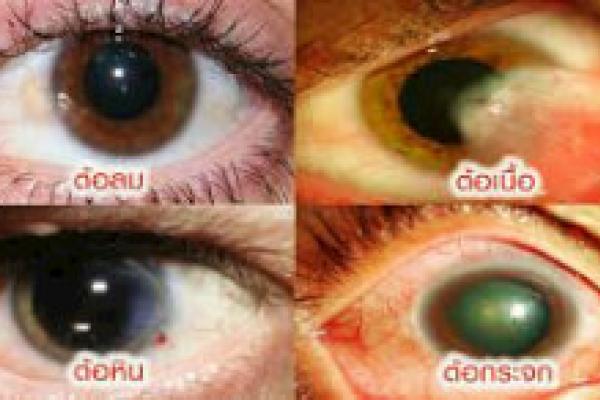 ดวงตาไม่ออกแบบมาให้กัน uv ใส่แว่นเถอะครับ